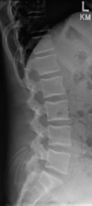 Degenerative Disc Disease
