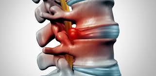 Facing Disc Injuries